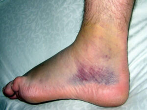 sprained immediately ankles quickly ankle