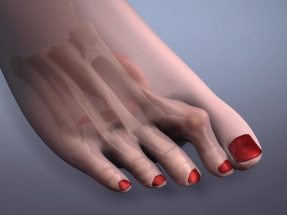 Pain Under Your Big Toe How To Treat Sesamoiditis Foot Houston