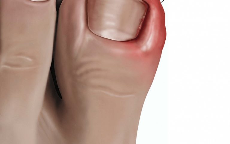 Dealing with Painful Ingrown Toenails
