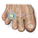 Neuroma foot treatment