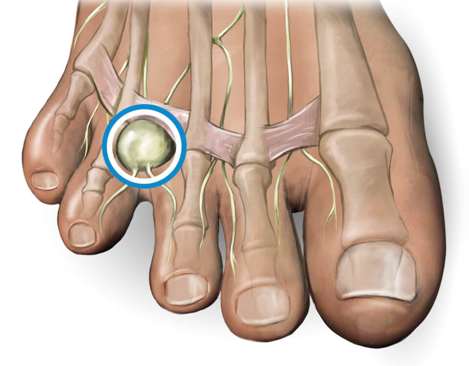 Neuroma foot treatment