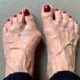 Why Early Bunion Treatment Is Key to Healthy, Pain-Free Feet?