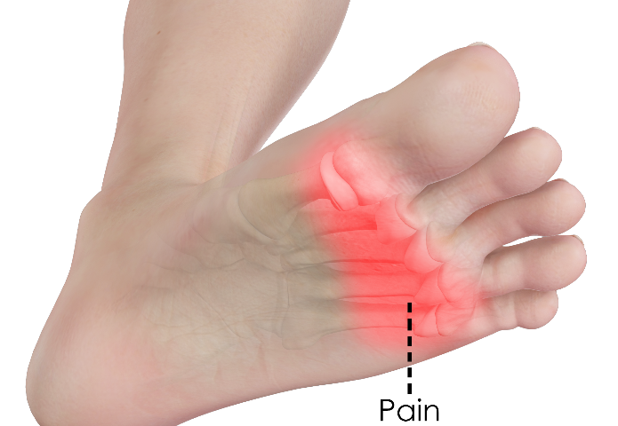 Pain in the ball of the foot