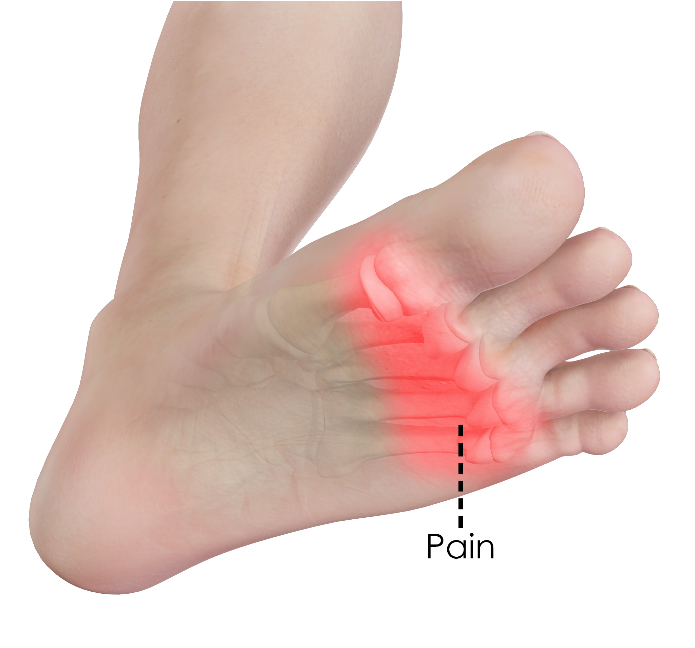 Pain in the ball of the foot